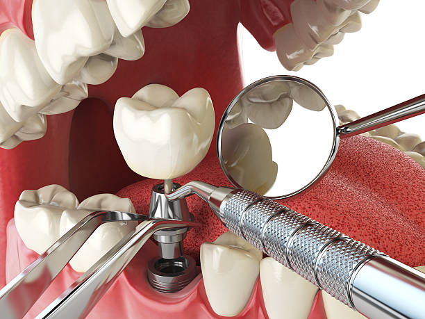 Best Emergency Treatment for Dental Infections or Abscesses in Socorro, NM